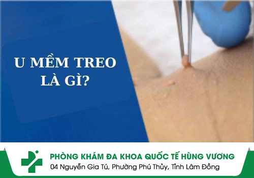 U mềm treo là gì? Cách điều trị u mềm treo hiệu quả