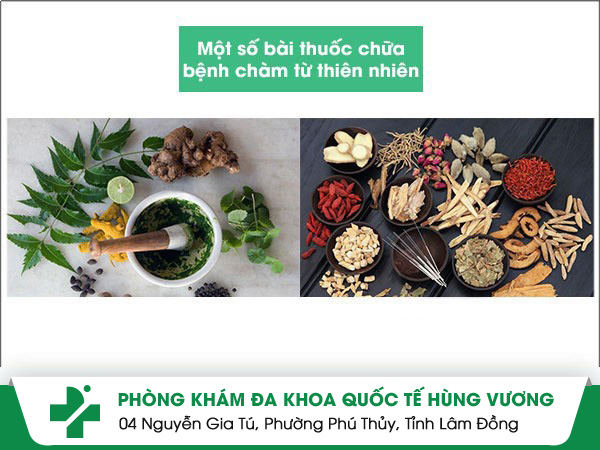 Bài thuốc trị chàm bằng thiên nhiên người bệnh nên tham khảo