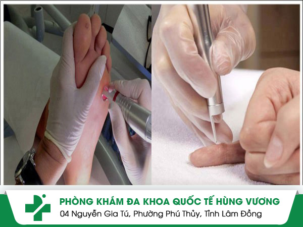 Bắn mụn cóc bằng công nghệ mới Laser CO2 Fractional tiên tiến