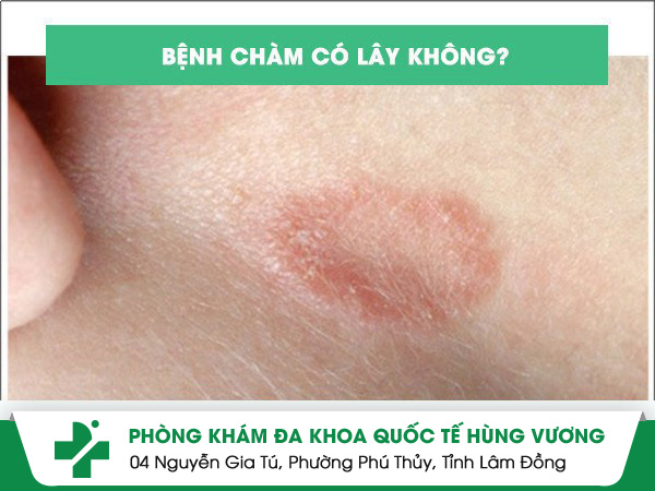Bệnh Chàm Có Lây Không?