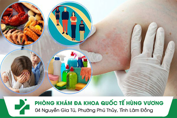 Bệnh chàm là gì? Tư vấn cách chữa trị hiệu quả, an toàn