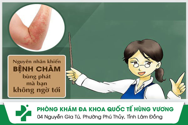 Bệnh chàm: Nguyên nhân, biểu hiện và cách trị hiệu quả