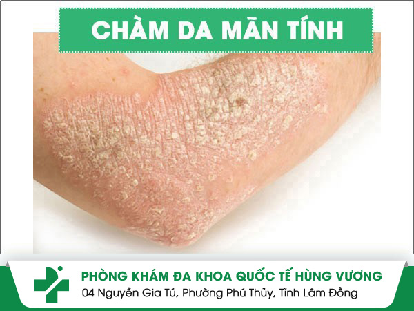 Bệnh chàm - những tác hại nguy hiểm mà bạn không ngờ tới