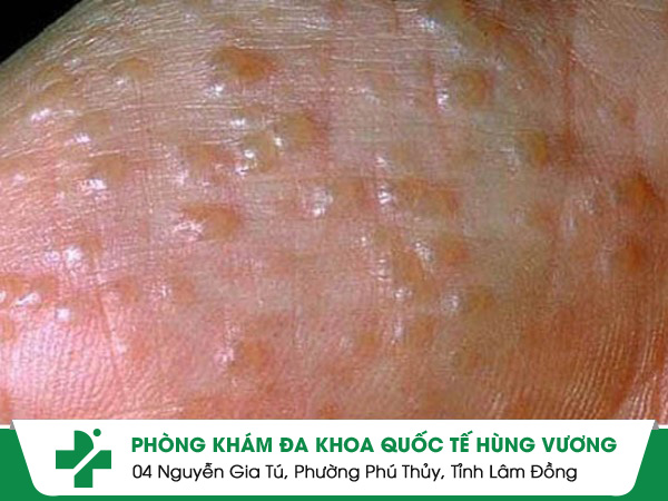 Thế nào là bệnh chàm nước?