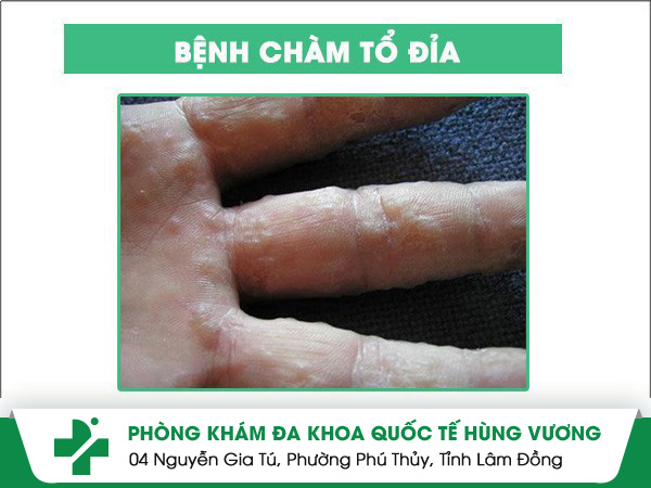 Hình ảnh bệnh chàm tổ đỉa. bệnh chàm tổ đỉa