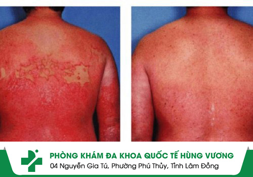 Bệnh Đỏ Da – Không Đơn Giản Chỉ Là 
