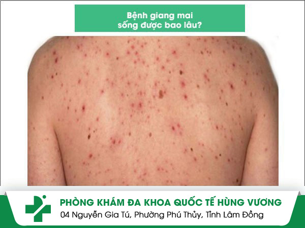 Chuyên gia y tế giải đáp bệnh giang mai sống được bao lâu?