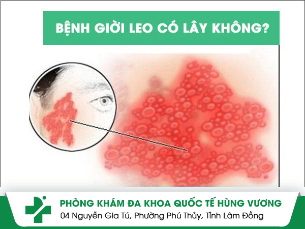 Bệnh giời leo có lây không?
