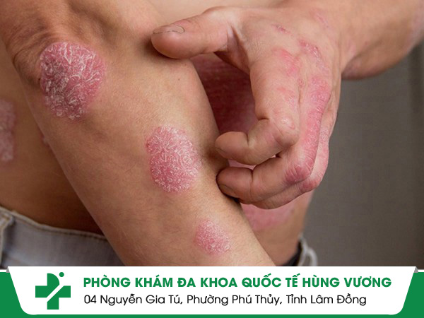 Bệnh nấm chàm là gì? Điều trị bệnh nấm chàm như thế nào?