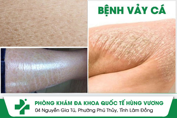 Bệnh Vảy Cá: Nguyên Nhân, Dấu Hiệu Và Phác Đồ Điều Trị Hiệu Quả