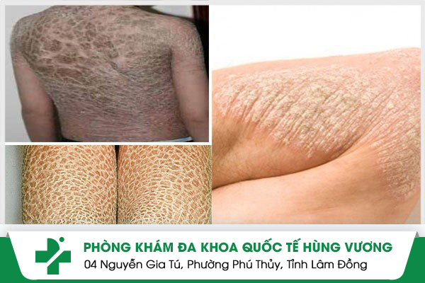 Nguyên nhân, triệu chứng bệnh vảy cá và cách điều trị an toàn