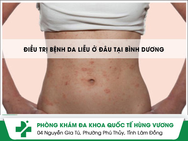 Thông tin bệnh viện da liễu Bình Dương uy tín chất lượng hàng đầu