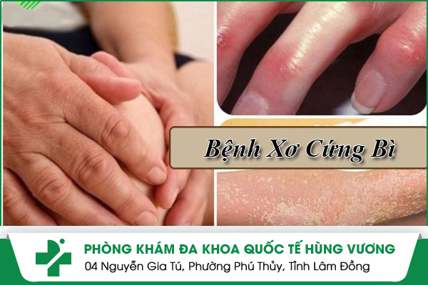 bệnh xơ cứng bì