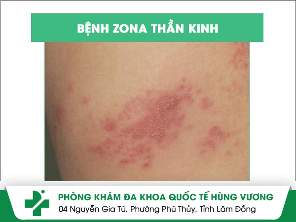 Thuốc trị zona thần kinh hiệu quả cao
