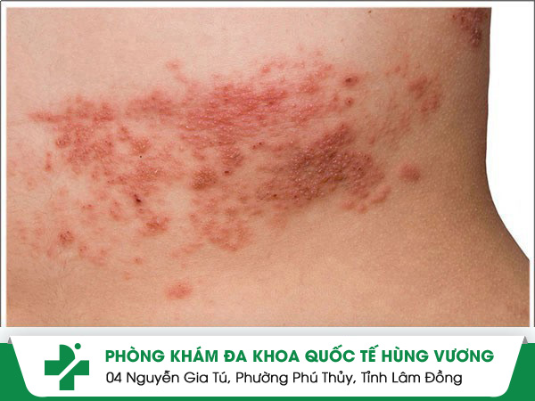 Bệnh Zona: Dấu Hiệu, Nguyên Nhân & Cách Điều Trị Sớm Tránh Sẹo Lõm