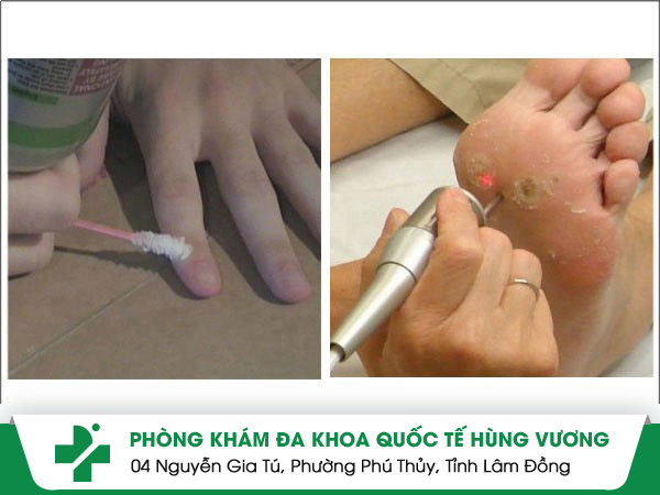 Bị mụn cóc phải làm sao hết nhanh không biến chứng?