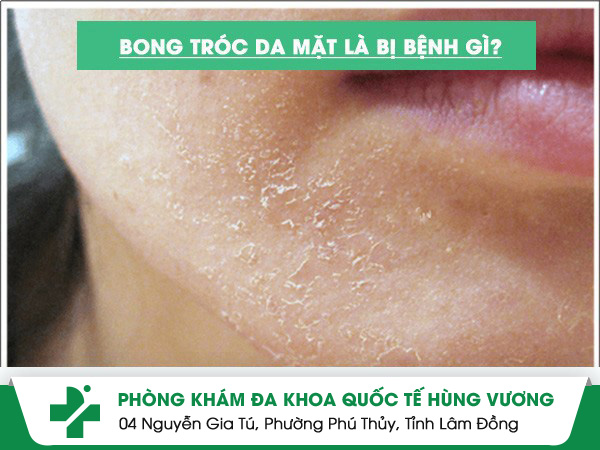Bong Tróc Da Mặt Và Cách Điều Trị Hiệu Quả