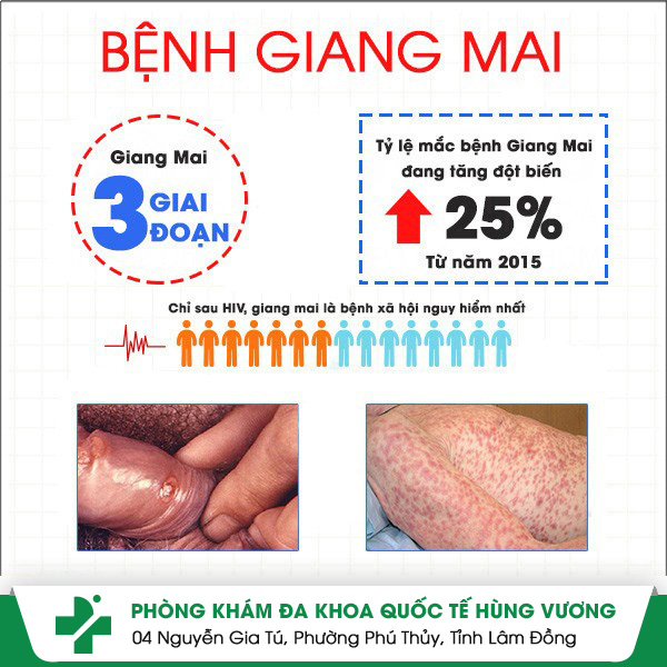 Các giai đoạn phát triển của giang mai