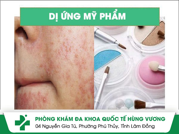 Các yếu tố liên quan đến tình trạng dị ứng mỹ phẩm