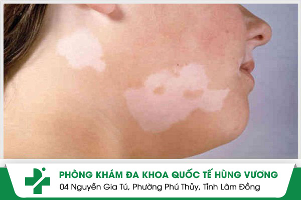 Bệnh bạch biến là gì Phân biệt bạch biến và bạch tạng