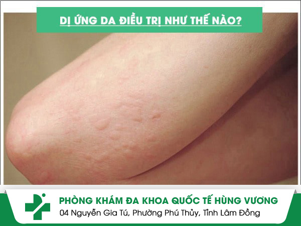 Cách điều trị dị ứng nhanh chóng hiệu quả