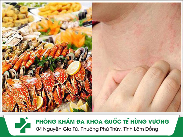 Những điều cần biết khi bị dị ứng hải sản