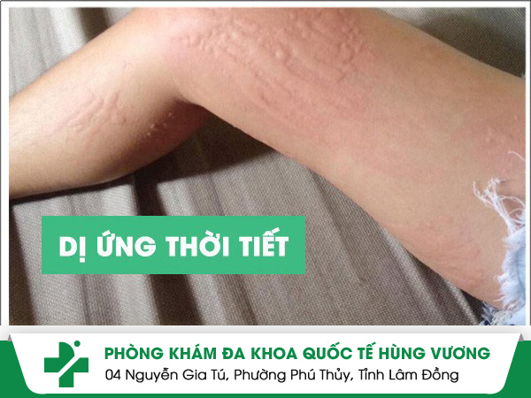 Dị ứng thời tiết là bệnh gì?