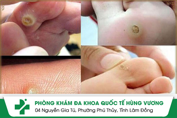 Cách điều trị mụn ké hiệu quả theo hướng đông tây y kết hợp