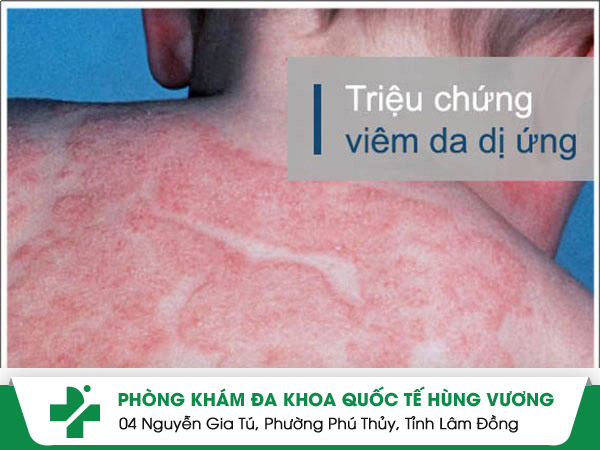 thuốc điều trị viêm da dị ứng