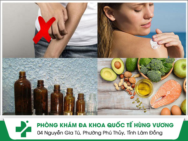 Cách phòng tránh bệnh chàm và điều trị bệnh chàm tiên tiến, hiệu quả nhất