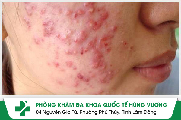 Đặc điểm của mụn viêm mặt và cách xử lý nhanh chóng