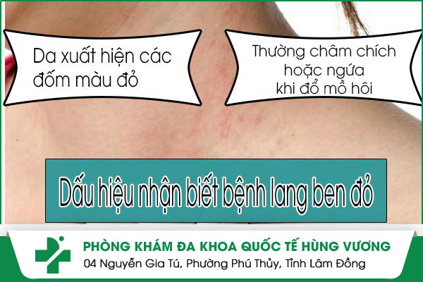 Những dấu hiệu nhận biết mắc bệnh lang ben đỏ