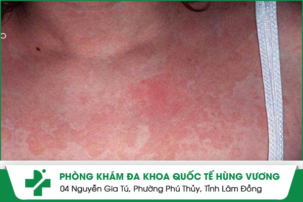 Hình ảnh về bệnh lang ben đỏ