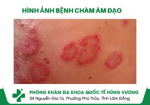 chàm âm đạo