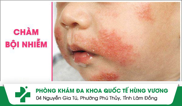 Chàm bội nhiễm mối hiểm họa khôn lường