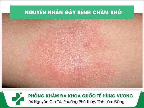 Nguyên nhân gây bệnh chàm khô và cách chữa trị tốt nhất
