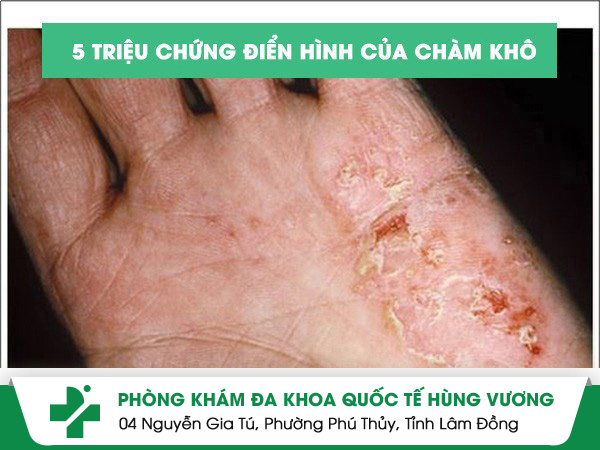 Chàm khô tay chân và cách điều trị hiệu quả
