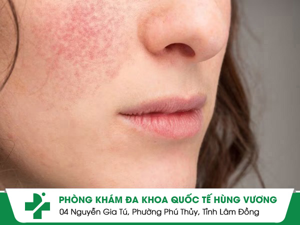 Chàm Mặt: Nguyên Nhân, Dấu Hiệu Và Phác Đồ Điều Trị Hiệu Quả Tại Phòng Khám Da Liễu Quận 10