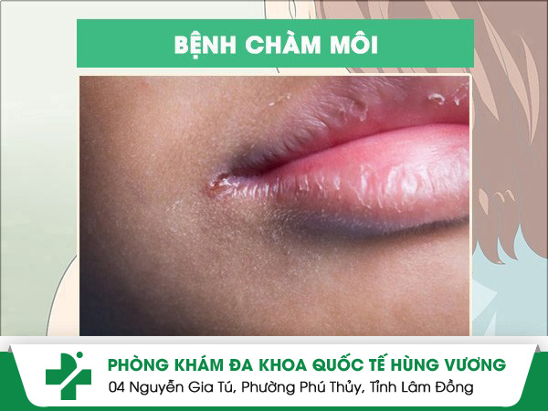 Chàm Môi: Nguyên Nhân – Dấu Hiệu – Hướng Điều Trị Được Bác Sĩ Khuyên Dùng