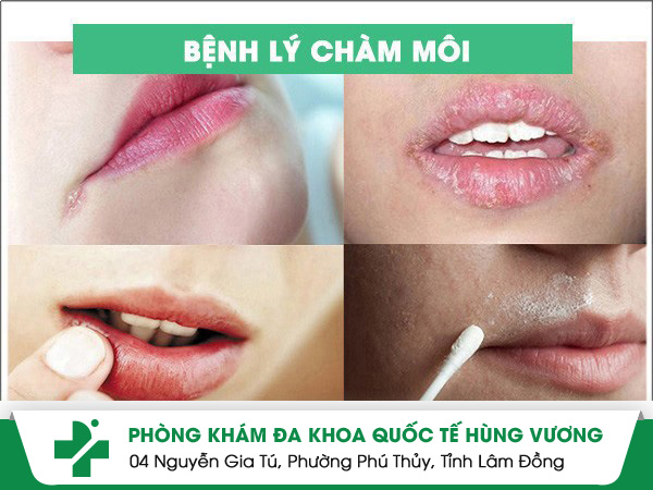 Đi tìm cách điều trị chàm môi an toàn và đơn giản