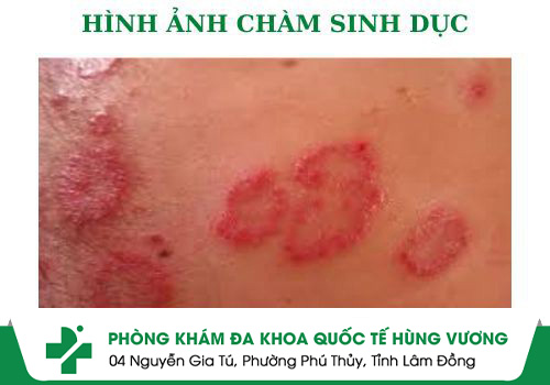 chàm sinh dục