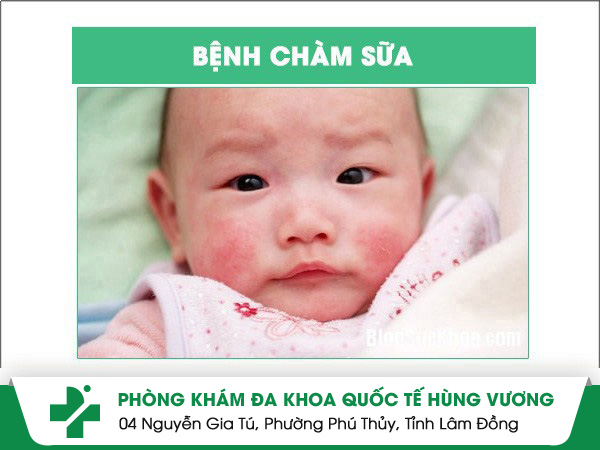 Tìm hiểu nguyên nhân và cách điều trị bệnh chàm sữa