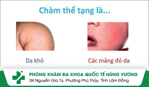 Chàm thể tạng nỗi lo lắng của các bậc cha mẹ