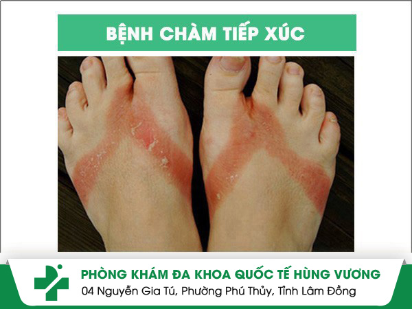 Tìm hiểu về bệnh chàm tiếp xúc và cách trị