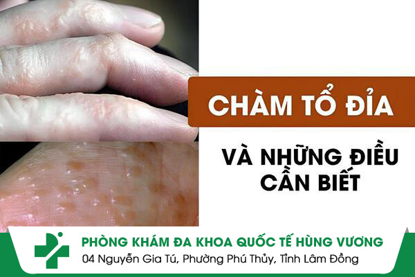 Bệnh Chàm Tổ Đỉa – Kẻ Thù Thầm Lặng Của Làn Da Bạn