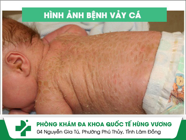 Chi phí hỗ trợ điều trị bệnh vảy cá