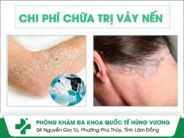 Chi phí chữa bệnh vảy nến là bao nhiêu?