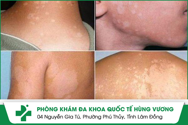 Hình ảnh về bệnh lang ben trắng