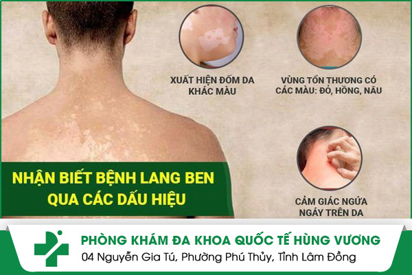 Dấu hiệu nhận biết bệnh lang ben trắng