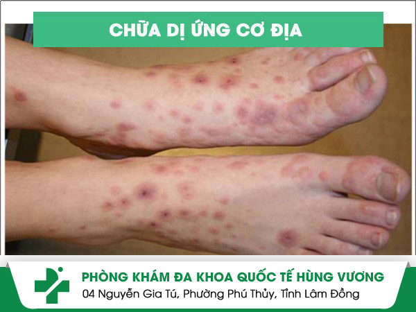 Chữa di ứng cơ địa hiệu quả nhanh, không lo tái phát